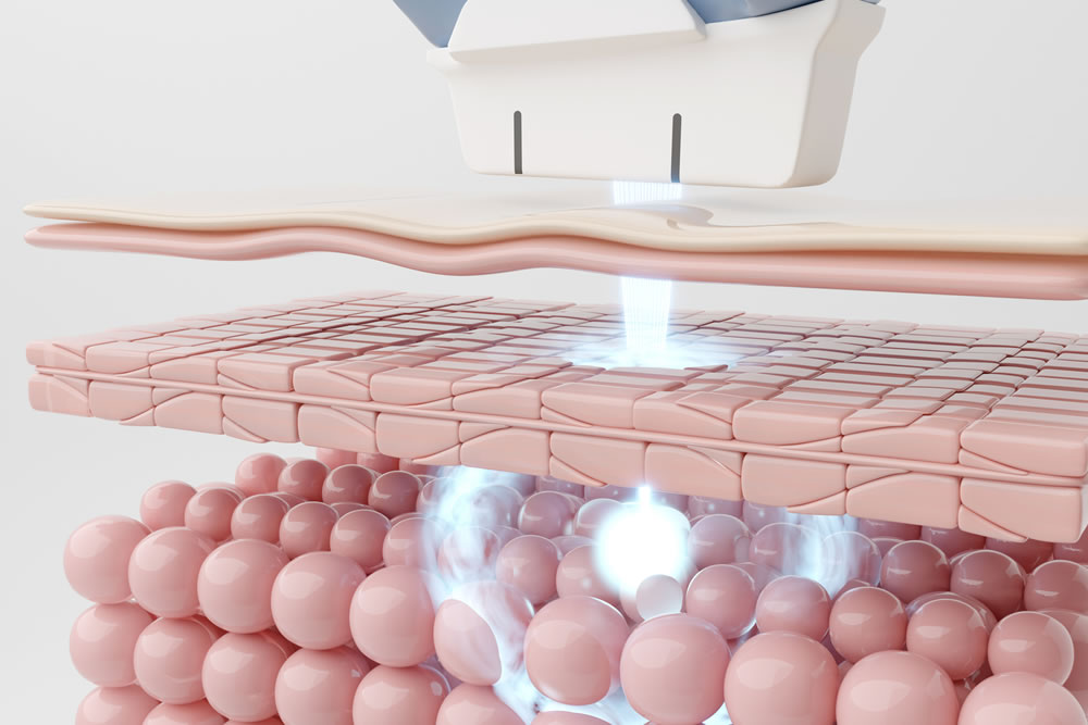 ハイフのイメージ