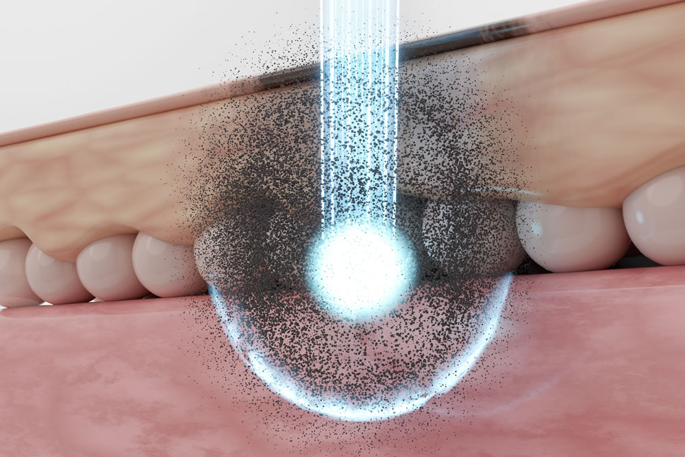 ピコレーザーのイメージ