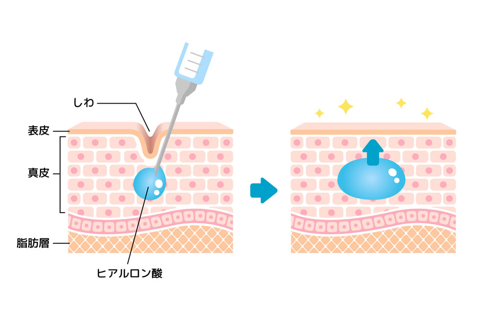 ヒアルロン酸の効果のイメージ