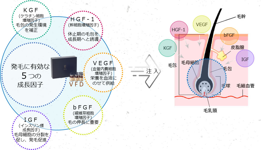 VFDの発毛の図解